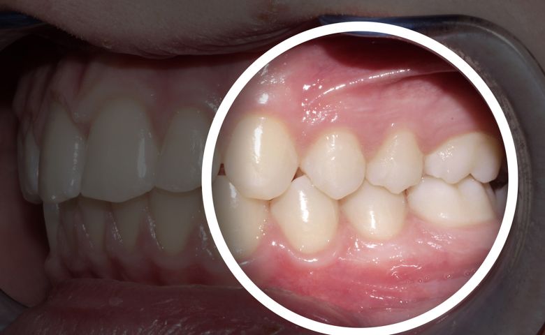 Teeth whitening