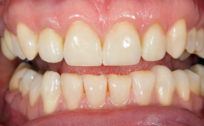 Teeth whitening