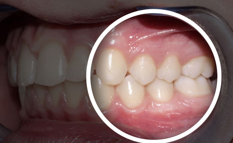 Veneers