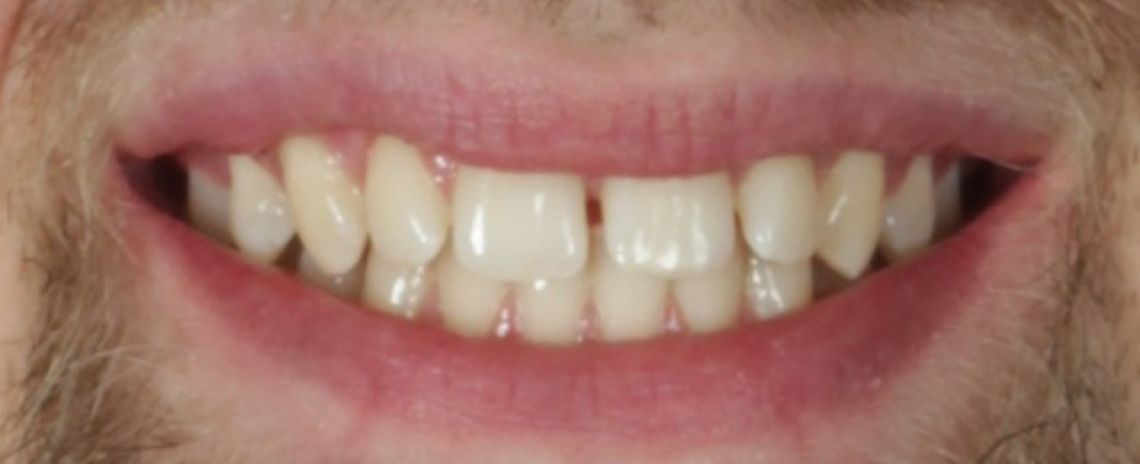 Before & After (Dr Sherry Mowla) Composite Bonding & Whitening  Before