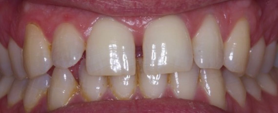 Before & After (Dr Sherry Mowla) Composite Bonding  Before