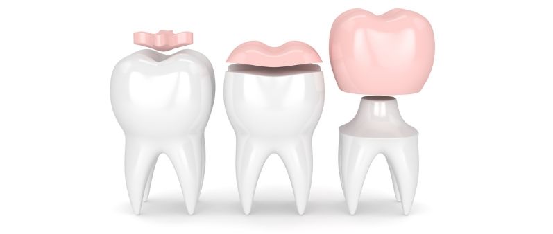 Inlays, Onlays and Dental Crowns