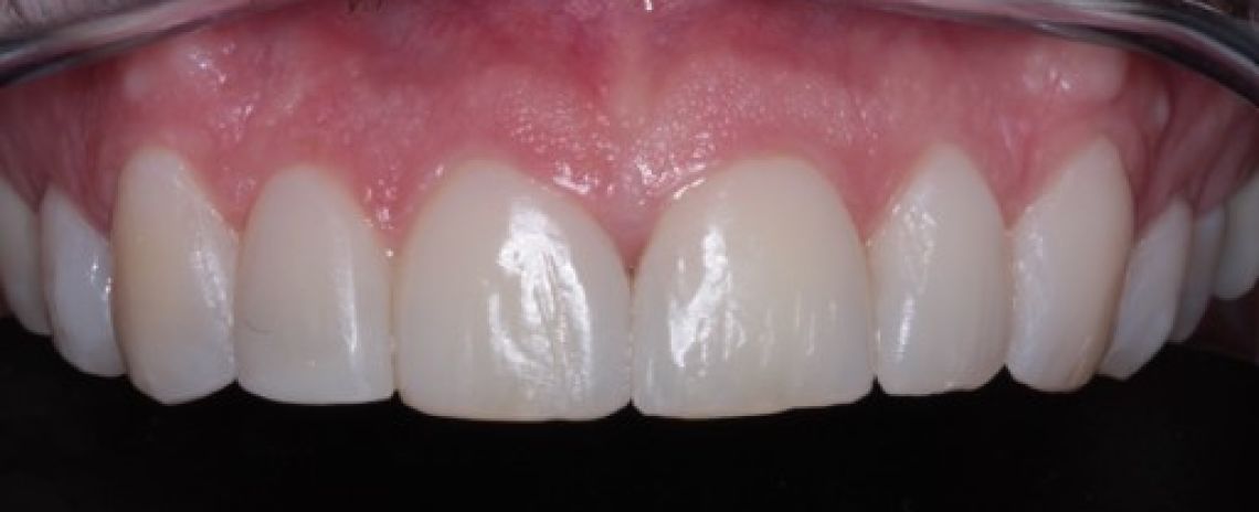 Before & After (Dr Sherry Mowla) Composite Bonding  After