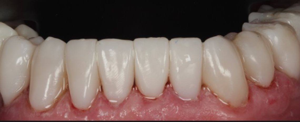 Before & After (Dr Sherry Mowla) Composite Bonding After