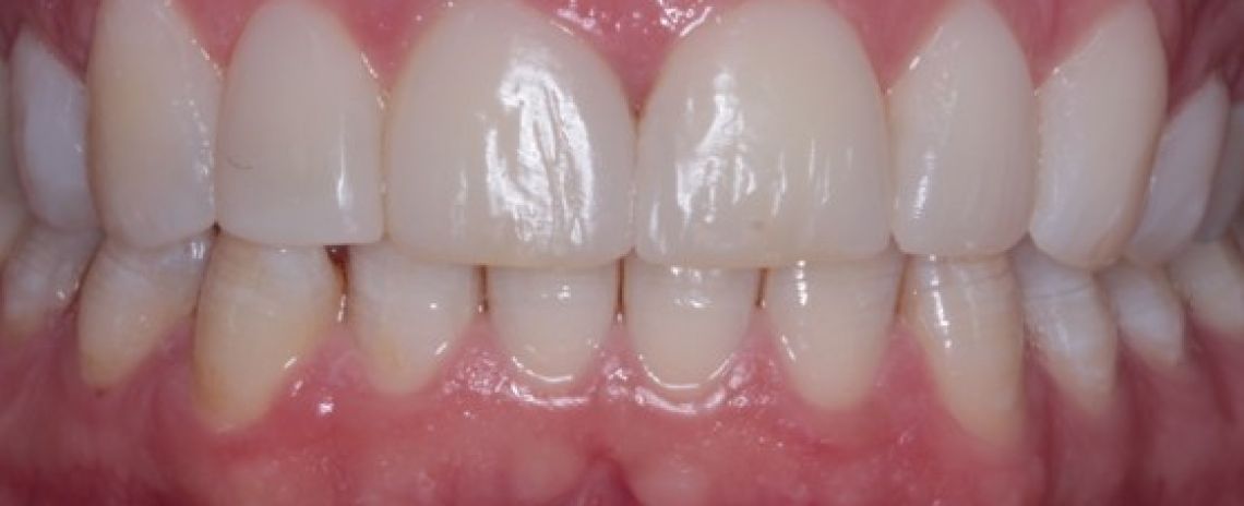 Before & After (Dr Sherry Mowla) Composite Bonding  After