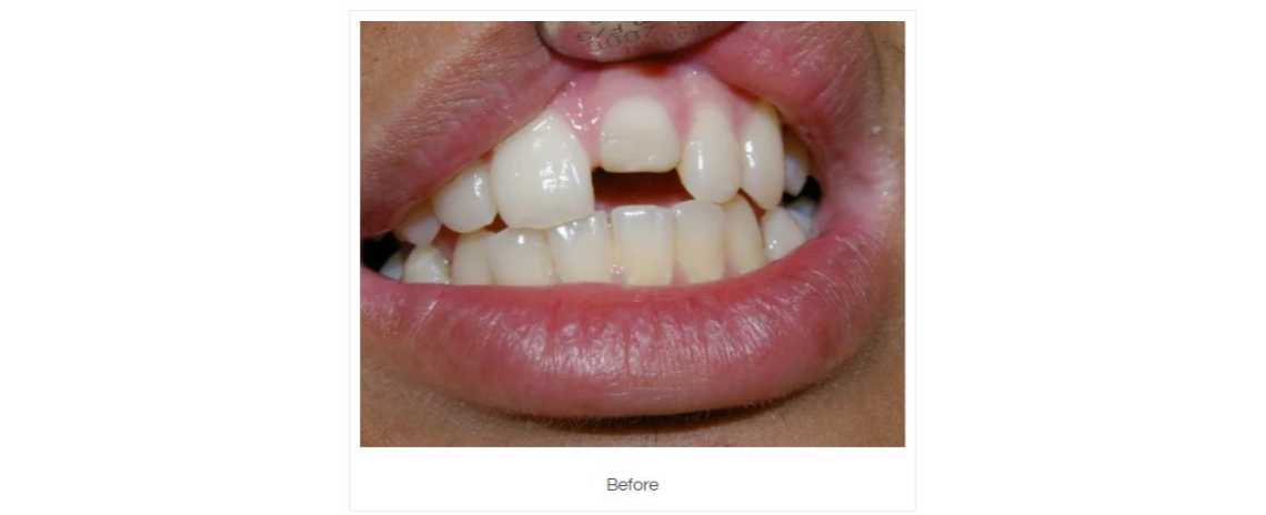 Fractured Tooth Repair Before