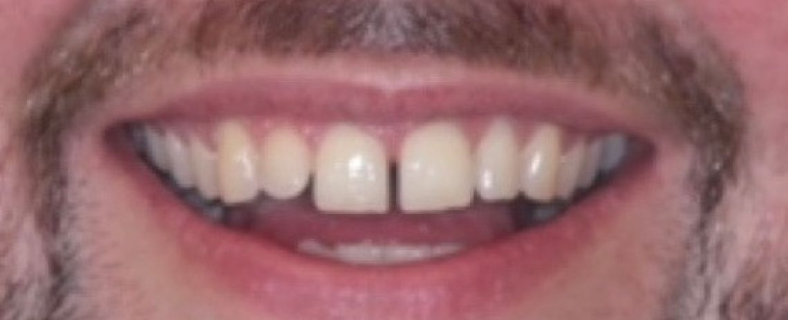 Before & After (Dr Sherry Mowla) Composite Bonding  Before