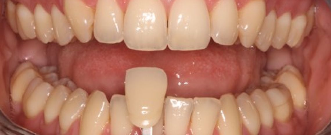 Before & After (Dr Sherry Mowla) Whitening  Before