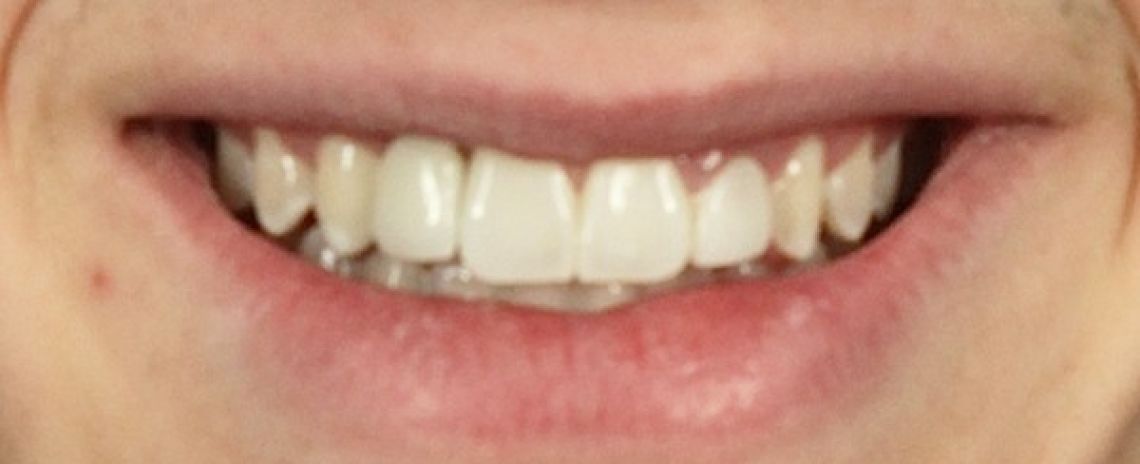 Before & After (Dr Sherry Mowla) Composite bonding and adhesive bridge After