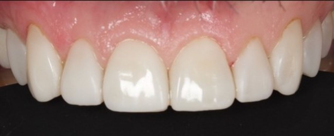 Before & After (Dr Sherry Mowla) Composite Bonding & Whitening  After
