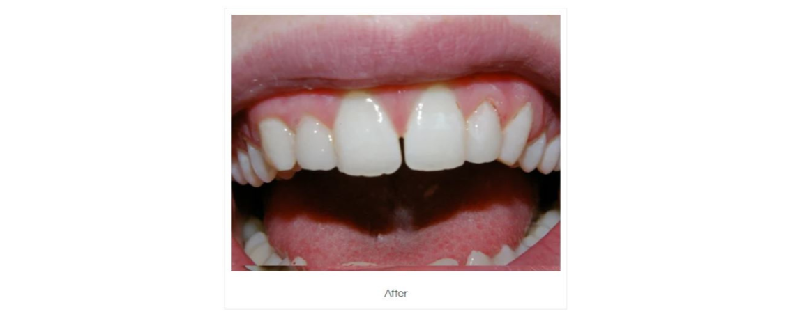  Composite White Fillings placed over small incisors After