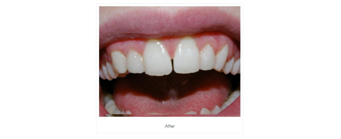 Composite White Fillings placed over small incisors After