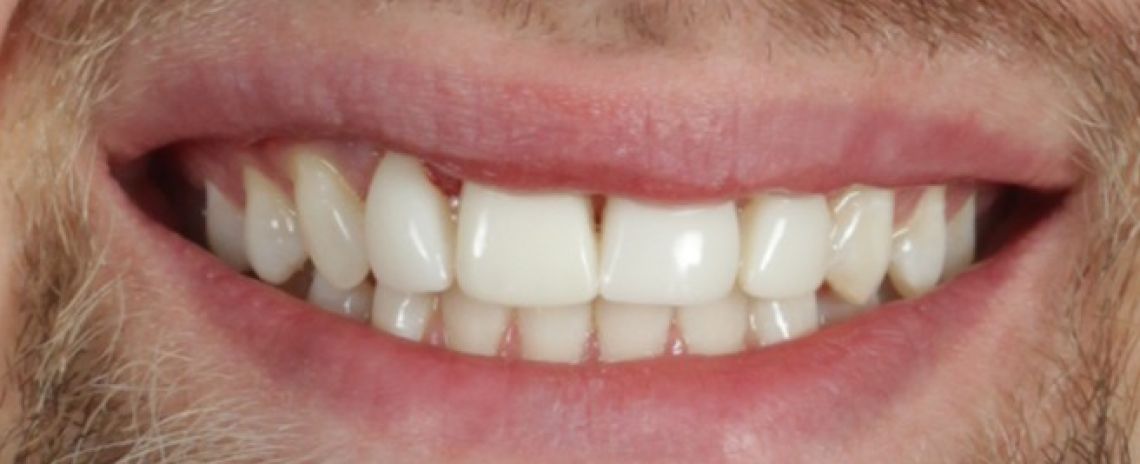 Before & After (Dr Sherry Mowla) Composite Bonding & Whitening  After