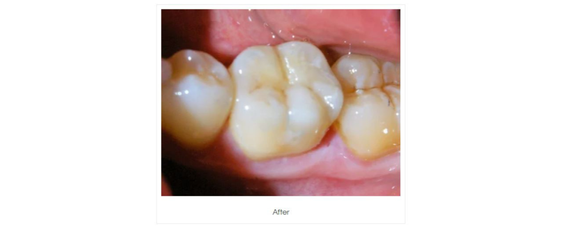  Amalgam removal and composite fillings After