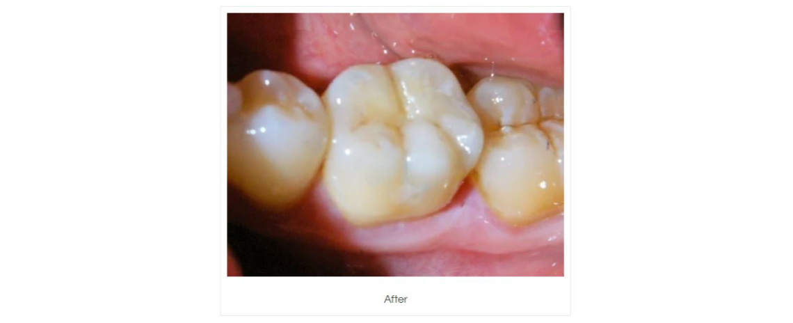 Amalgam removal and composite fillings After
