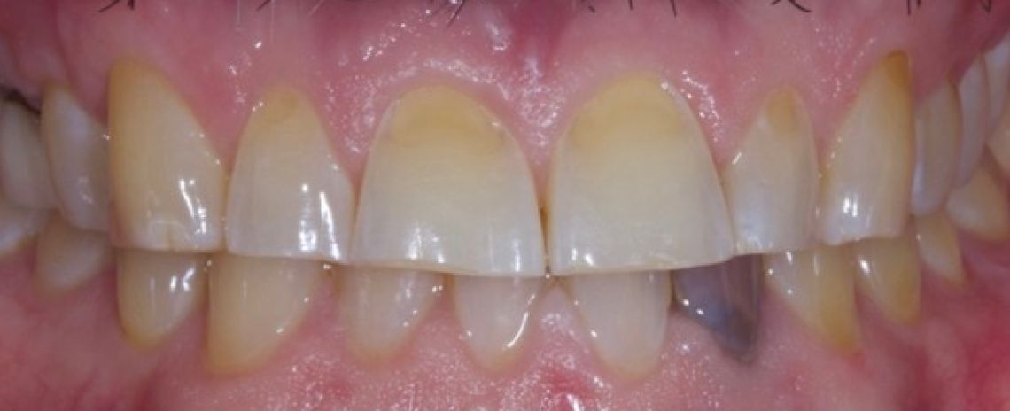 Before & After (Dr Sherry Mowla) Composite Bonding & Whitening  Before