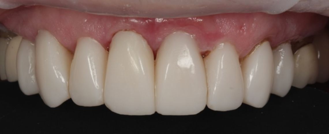 Before & After (Dr Sherry Mowla) Composite Bonding  After