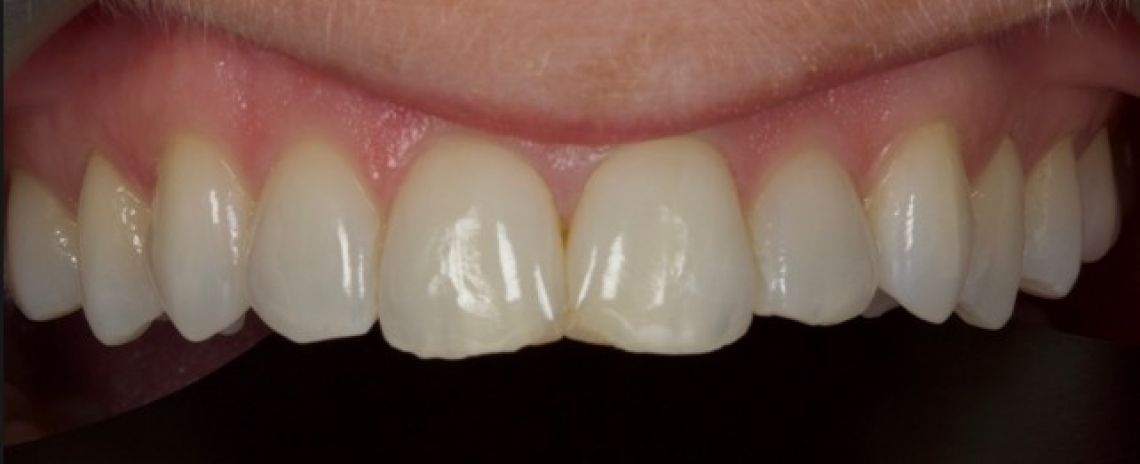 Before & After (Dr Sherry Mowla) Composite Bonding & Whitening  Before