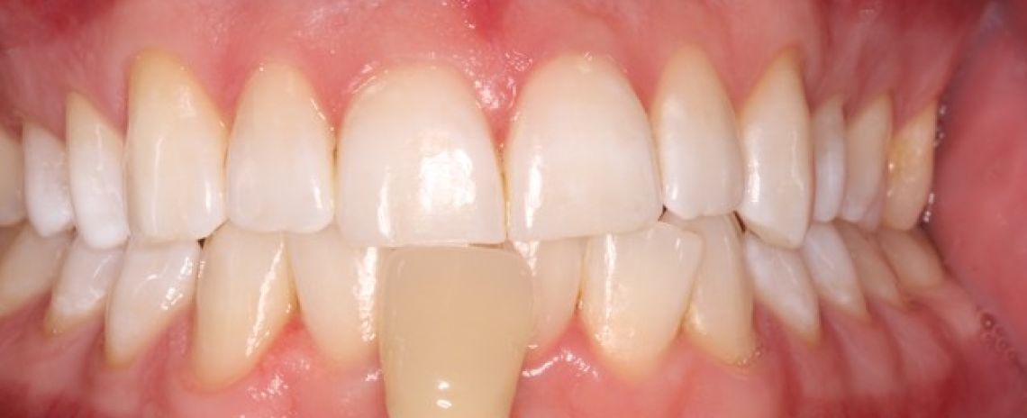 Before & After (Dr Sherry Mowla) Whitening  After