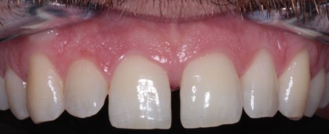 Before & After (Dr Sherry Mowla) Composite Bonding  Before