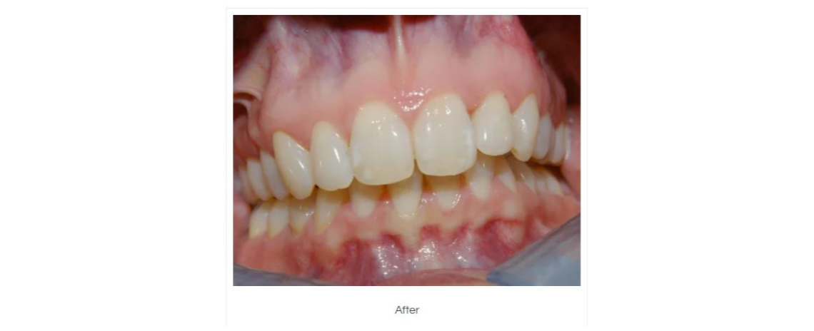 Clear Aligner (Over 8 weeks) After