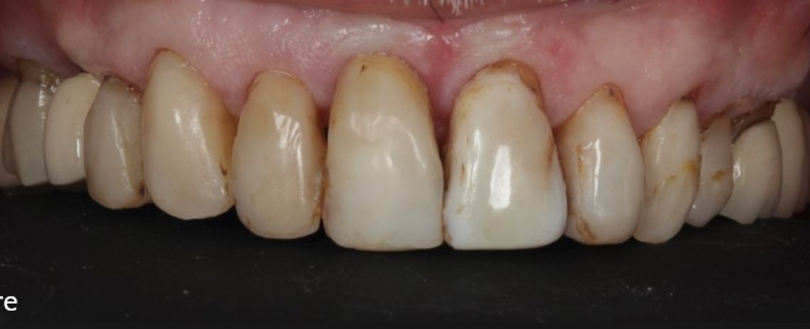 Before & After (Dr Sherry Mowla) Composite Bonding  Before