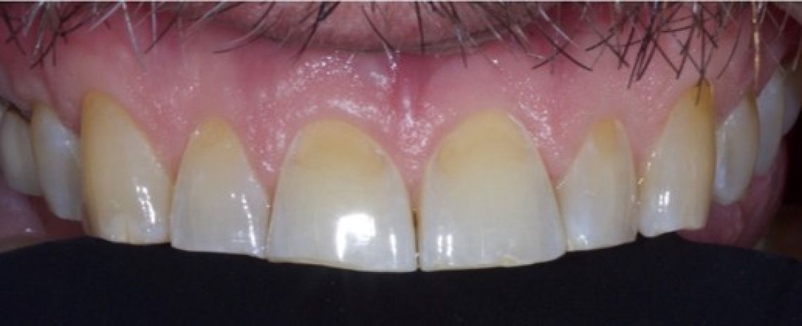 Before & After (Dr Sherry Mowla) Composite Bonding & Whitening  Before