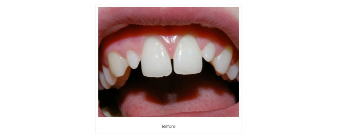  Composite White Fillings placed over small incisors Before