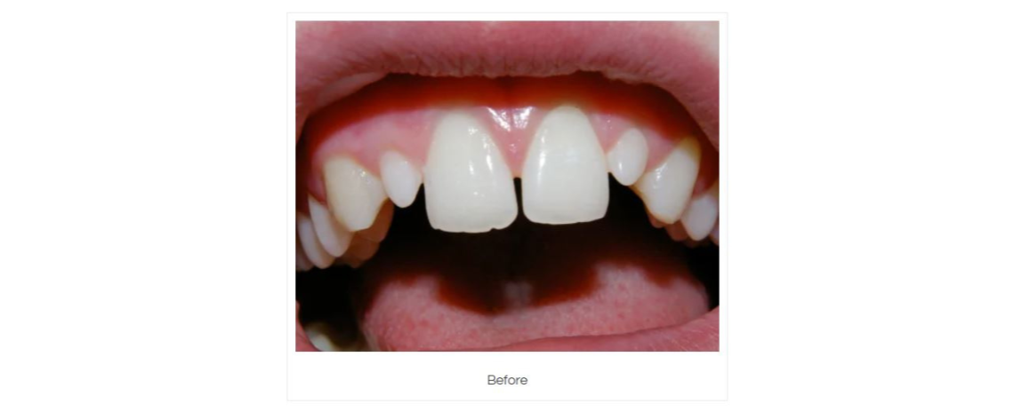 Composite White Fillings placed over small incisors Before