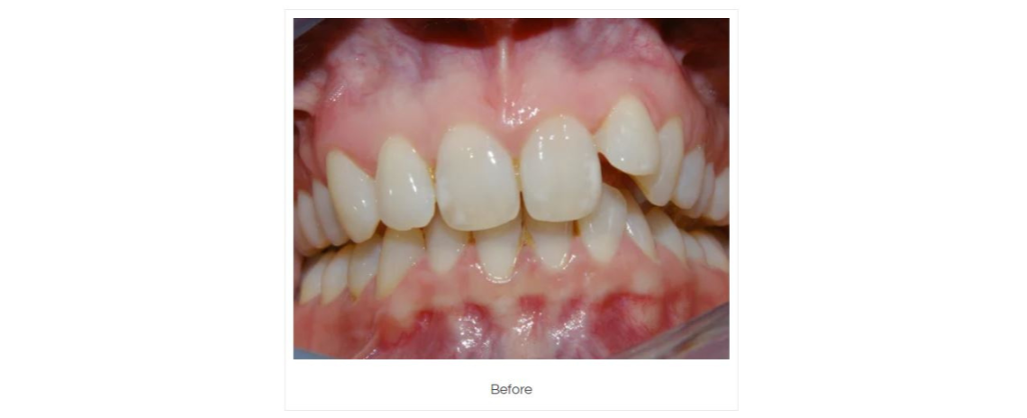 Clear Aligner (Over 8 weeks) Before