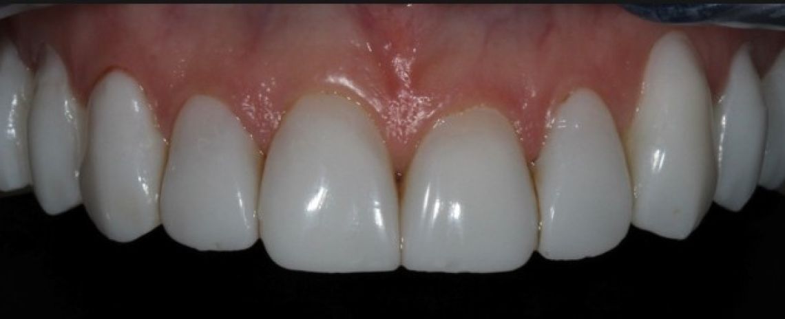 Before & After (Dr Sherry Mowla) Composite Bonding & Whitening  After
