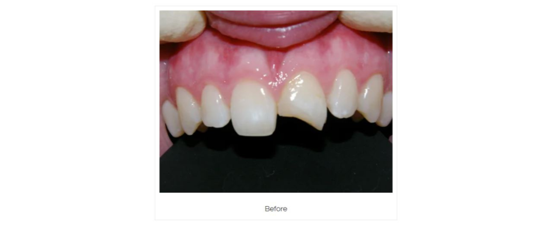  Tooth repair using composite fillings Before
