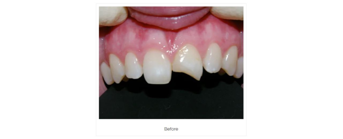 Tooth repair using composite fillings Before