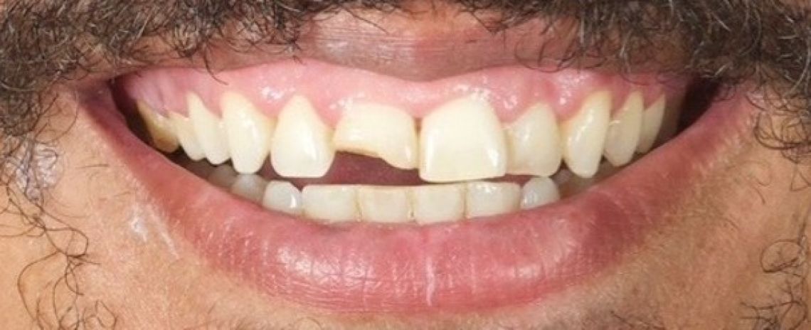 Before & After (Dr Sherry Mowla) Composite Bonding  Before