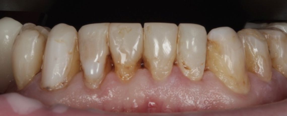 Before & After (Dr Sherry Mowla) Composite Bonding Before