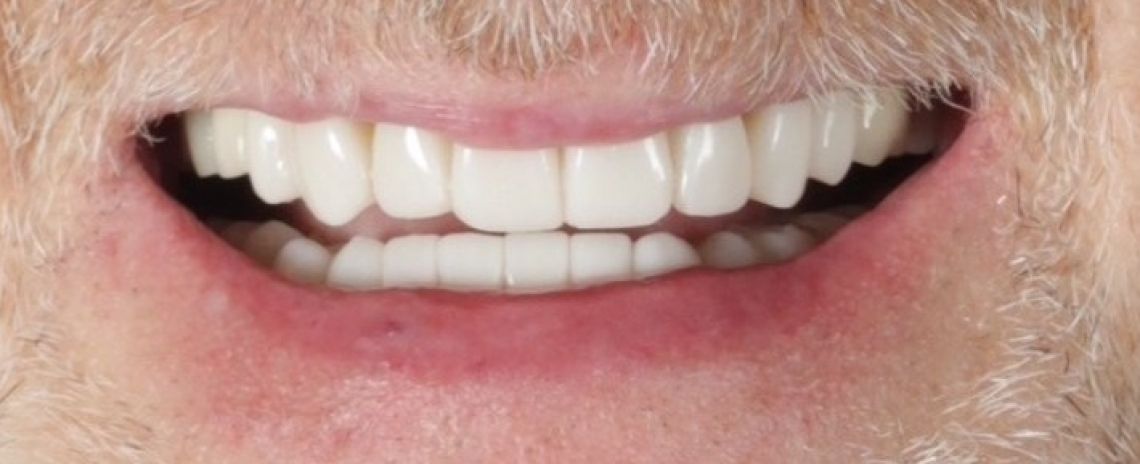 Before & After (Dr Sherry Mowla) Composite Bonding  After