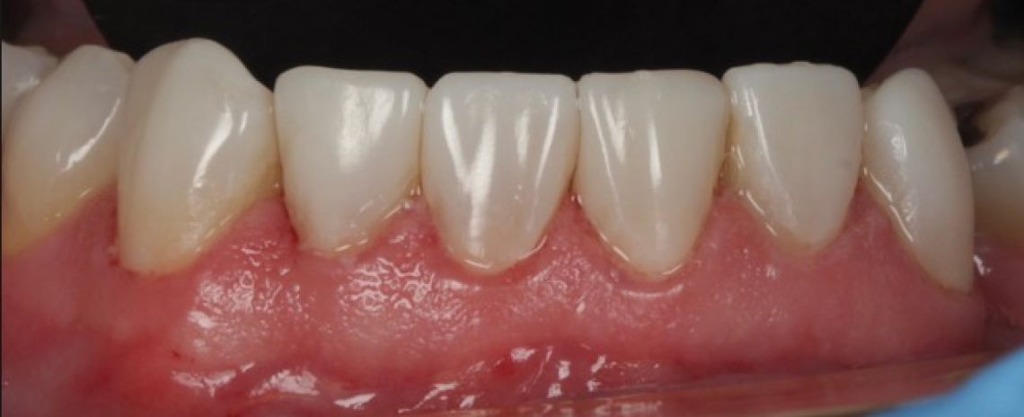 Before & After (Dr Sherry Mowla) Composite Bonding & Whitening  After