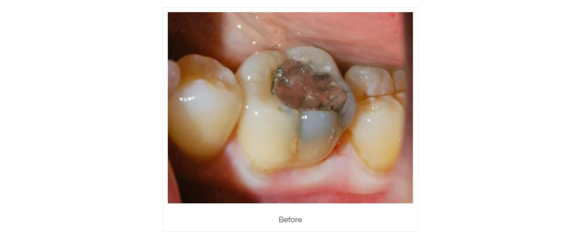  Amalgam removal and composite fillings Before