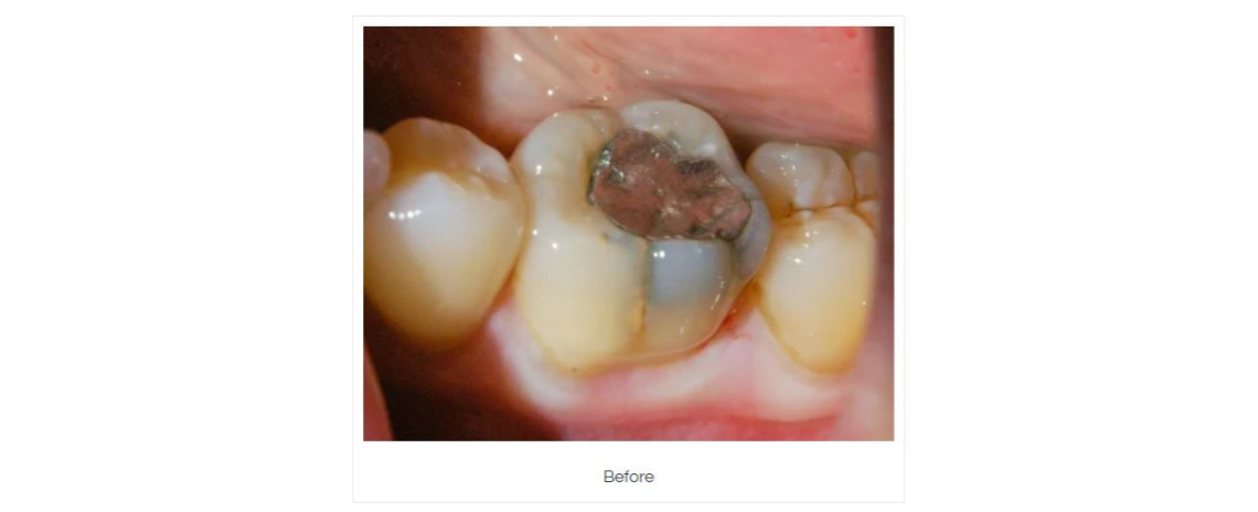 Amalgam removal and composite fillings Before
