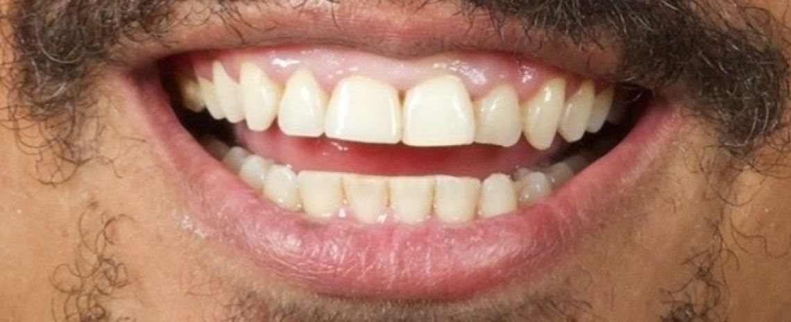 Before & After (Dr Sherry Mowla) Composite Bonding  After