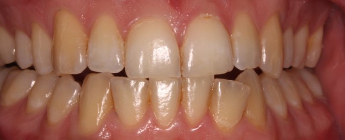 Before & After (Dr Sherry Mowla) Whitening  Before