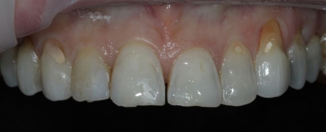 Before & After (Dr Sherry Mowla) Composite Bonding & Whitening  Before