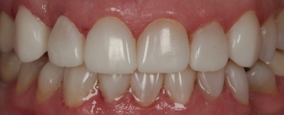 Before & After (Dr Sherry Mowla) Composite Bonding & Whitening  After
