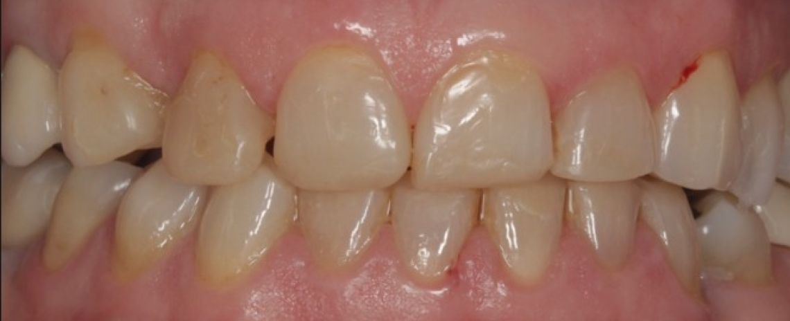 Before & After (Dr Sherry Mowla) Composite Bonding & Whitening  Before