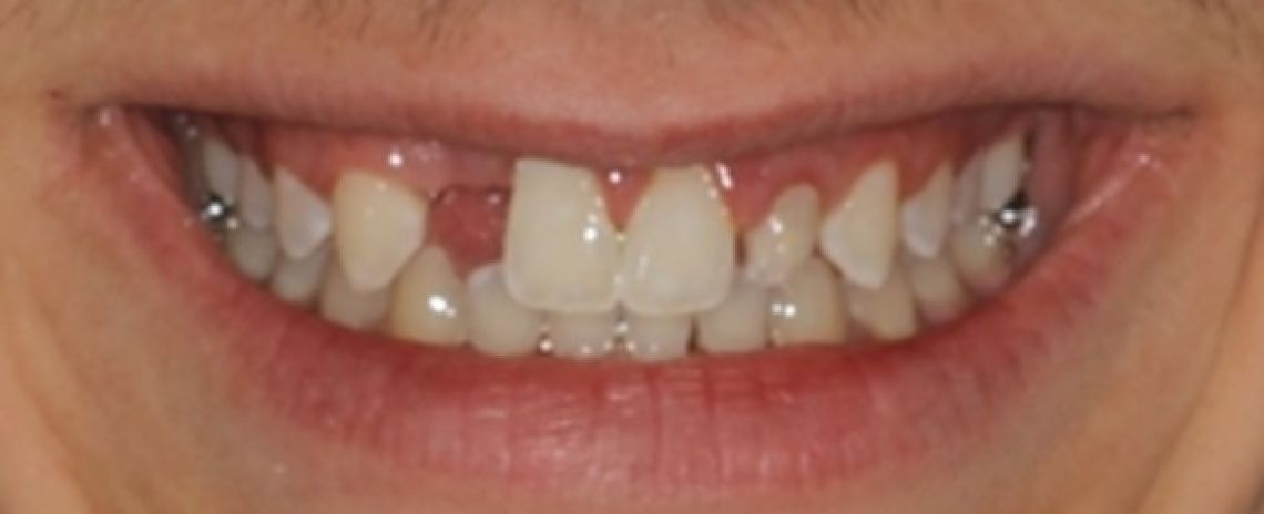 Before & After (Dr Sherry Mowla) Composite bonding and adhesive bridge Before