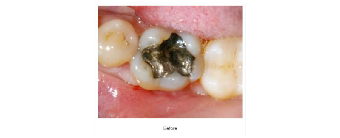  Amalgam removal and composite fillings Before