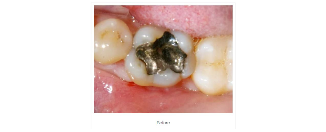 Amalgam removal and composite fillings Before