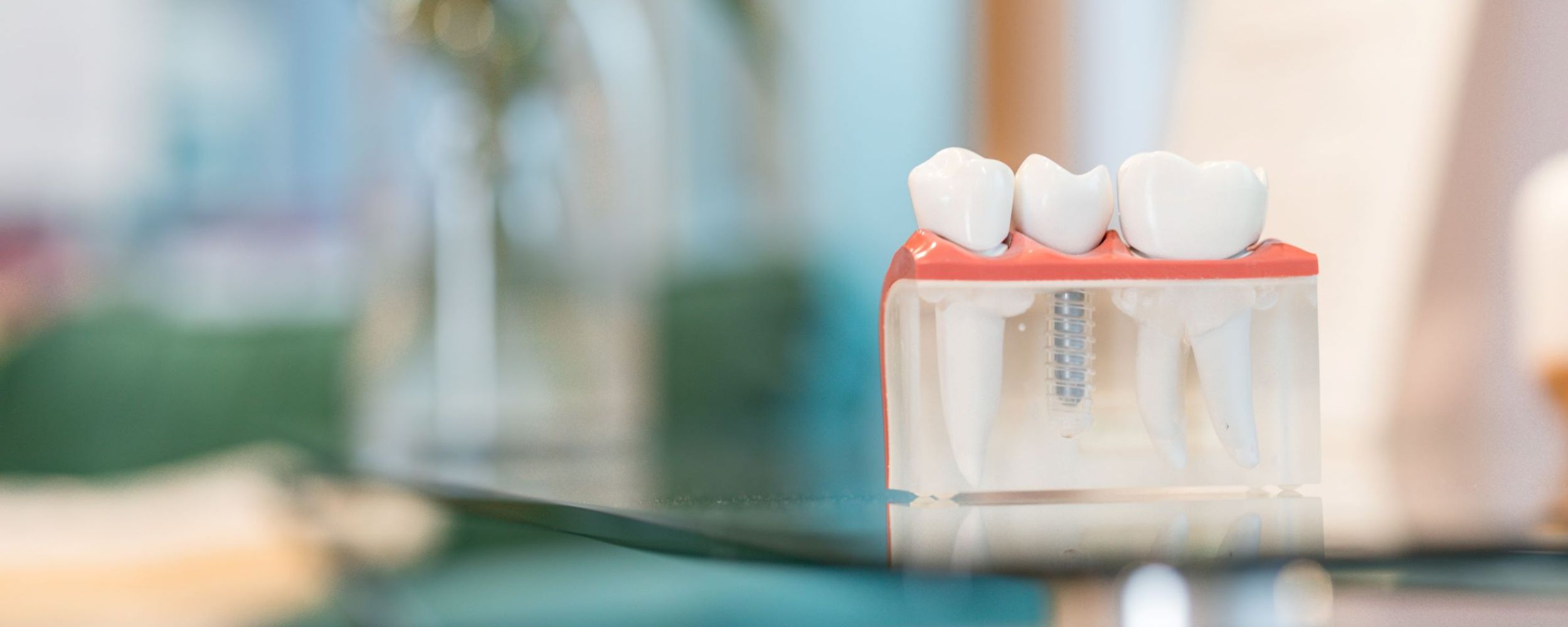 Dental implants