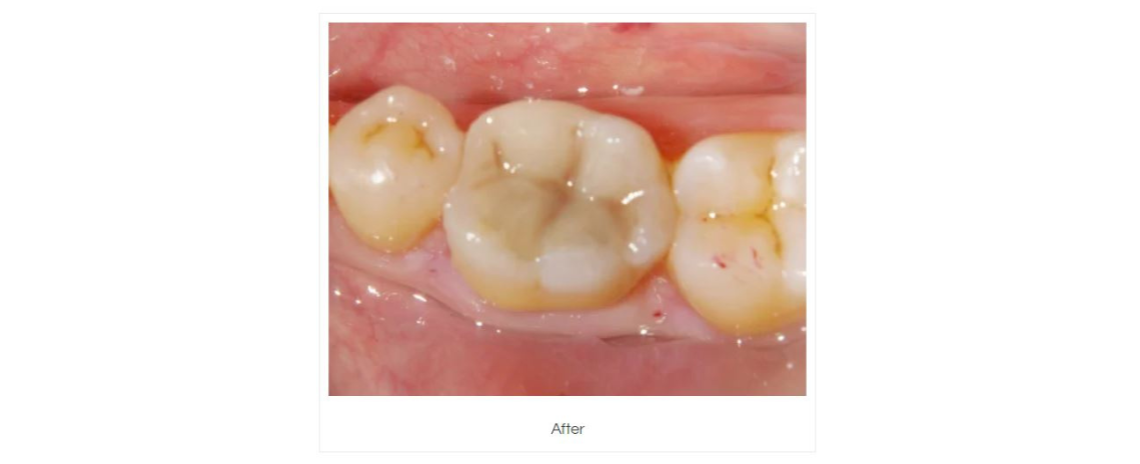 Amalgam removal and composite fillings After