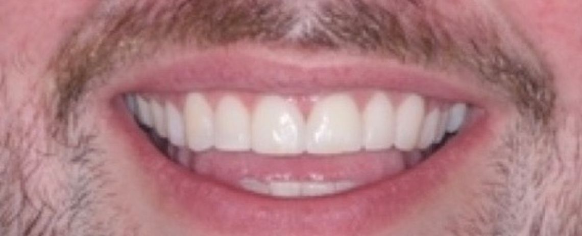 Before & After (Dr Sherry Mowla) Composite Bonding  After